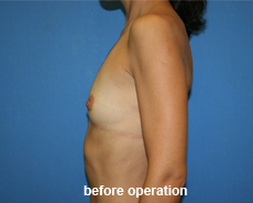 plastic-surgery-breast-augmentation